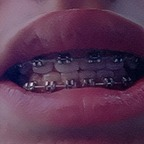 Leaked bracesfetish onlyfans leaked