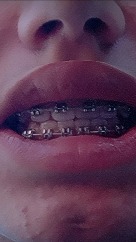 Leaked bracesfetish header onlyfans leaked